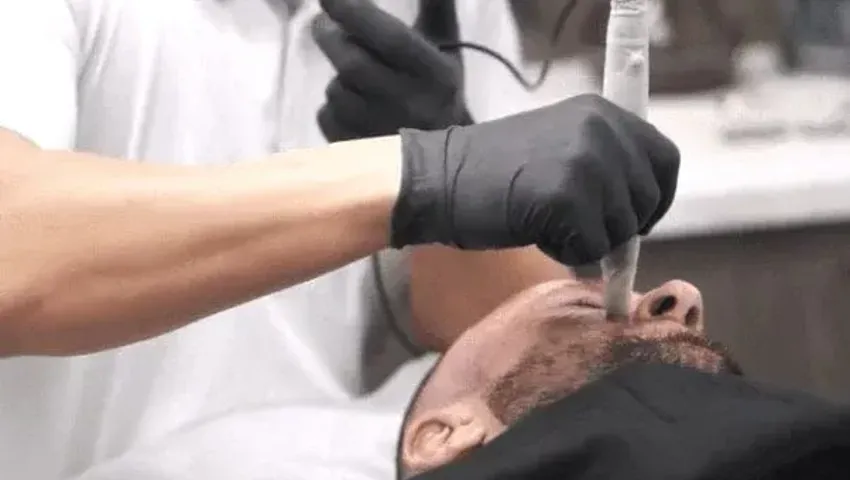 Imgi 9 Skin Needling.Jpg