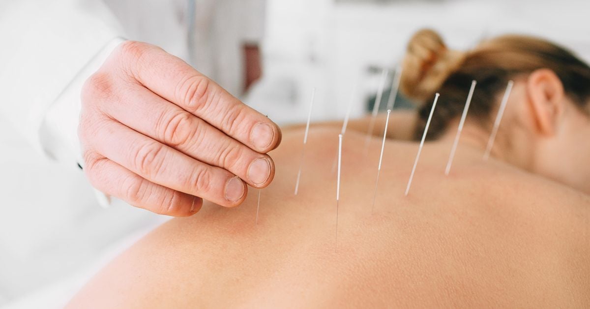 Acupuncture